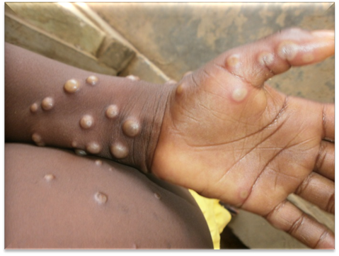 WHO Releases a Strategic Framework for Enhancing Prevention and Control of Monkeypox