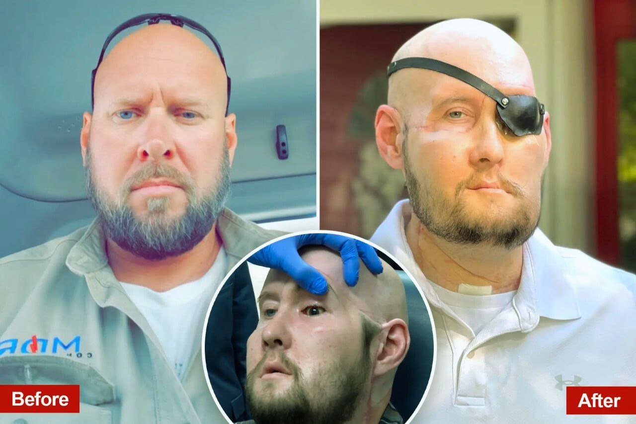 The First Successful Face Transplant with an Included Eye Shows Promising Results a Year Later